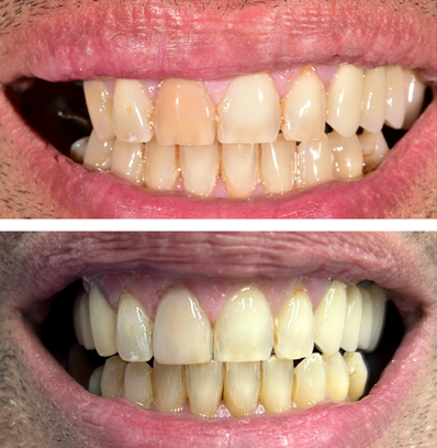 Πριν & Μετά Οδοντιατρικές υπηρεσίες