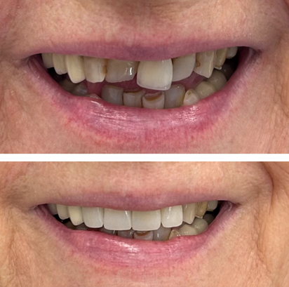 Μονολιθικες στεφανες ζιρκονιου