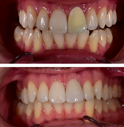 Μονολιθικη στεφανη ζιρκονιου