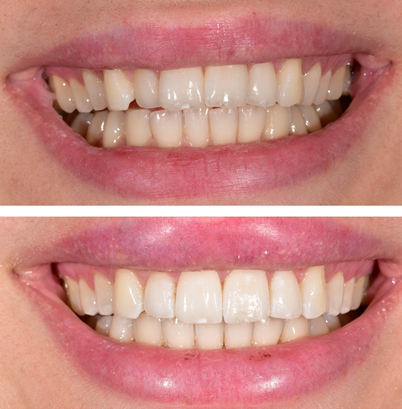 Ορθοδοντικη εργασια invisalign