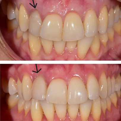 Τοποθετηση εμφυτευματος