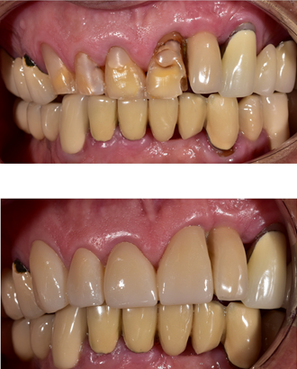 γεφυρα ζιρκονιου