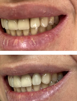 μονολιθικη στεφανη