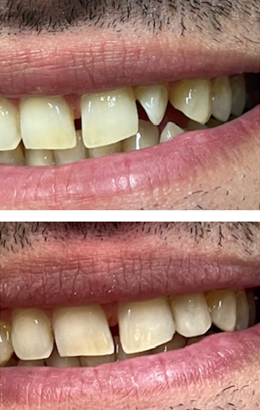 οψη ριτινης